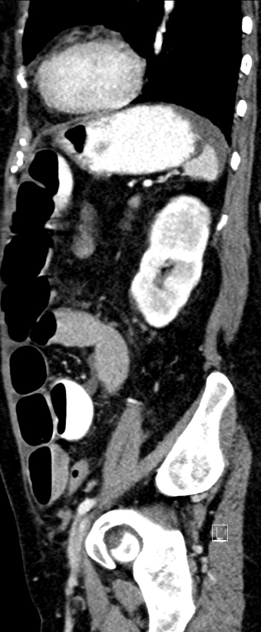 Broad ligament hernia (Radiopaedia 84802-100276 C 19).jpg