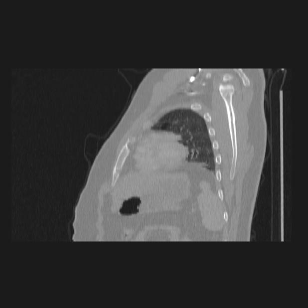 Bronchial atresia (Radiopaedia 60685-68439 Sagittal lung window 76).jpg