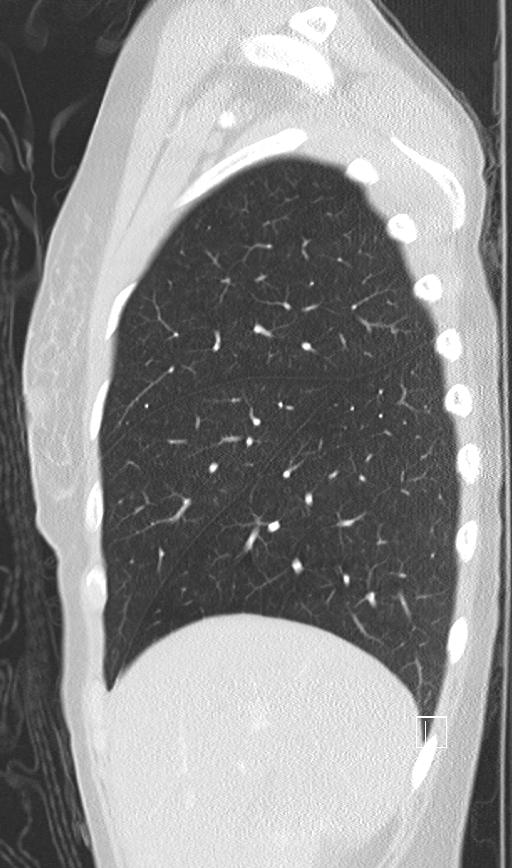 Bronchial atresia (Radiopaedia 73677-84470 Sagittal lung window 11).jpg