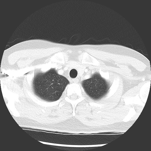 Bronchial carcinoid tumor (Radiopaedia 67377-76764 Axial lung window 11).jpg