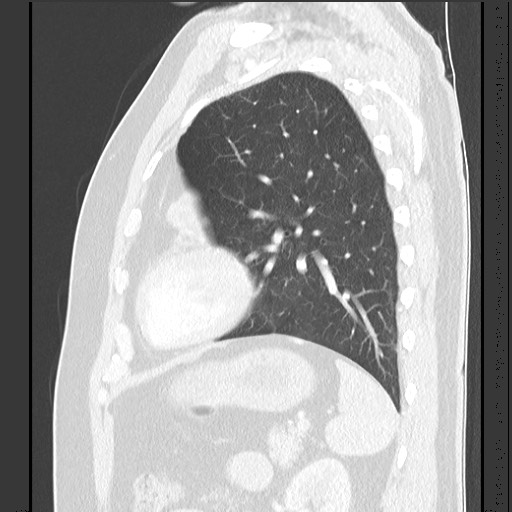File:Bronchial carcinoid tumor (Radiopaedia 67377-76764 Sagittal lung window 51).jpg