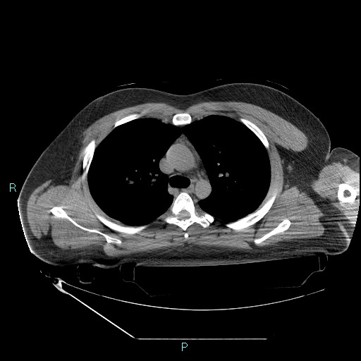 File:Bronchial carcinoid tumor (Radiopaedia 78272-90870 Axial non-contrast 35).jpg