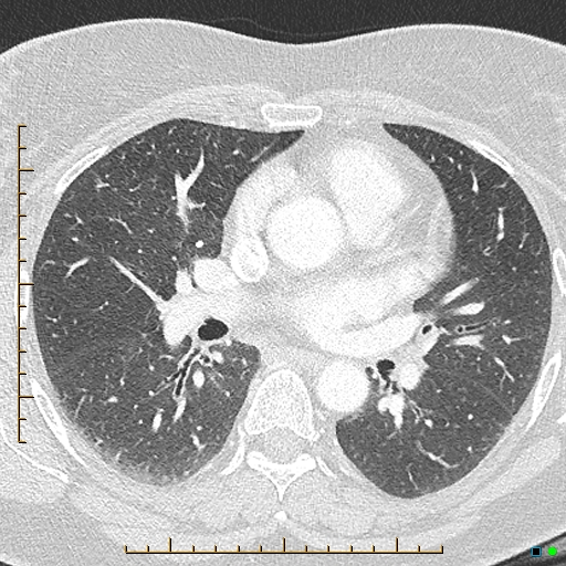 Bronchial diverticula (Radiopaedia 79512-92676 Axial lung window 96).jpg
