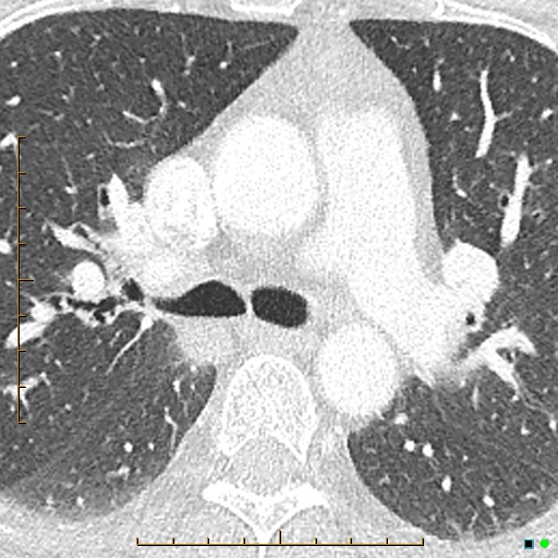 File:Bronchial diverticula (Radiopaedia 79512-92677 Axial lung window 6).jpg