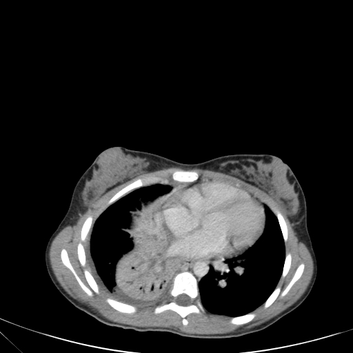 Bronchial mucoepidermoid carcinoma (Radiopaedia 57023-63895 Axial 62).jpg