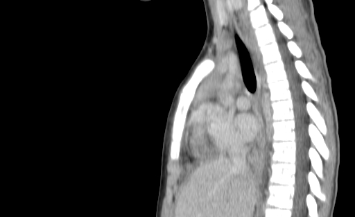 Bronchial mucoepidermoid carcinoma (Radiopaedia 57023-63895 Sagittal 113).jpg