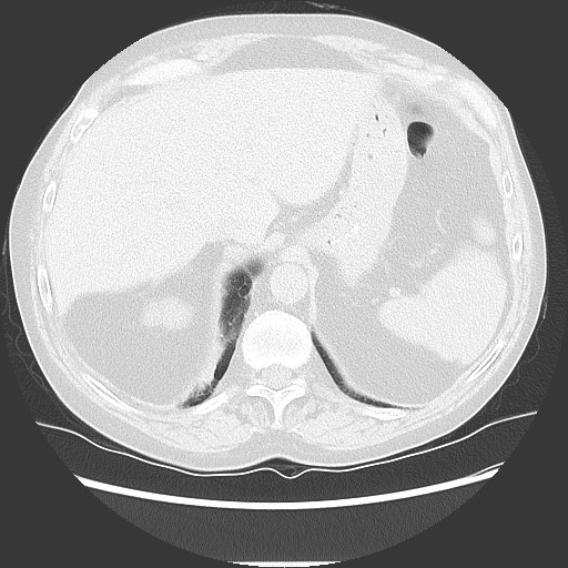 Bronchial stenosis - lung transplant (Radiopaedia 73133-83848 Axial lung window 55).jpg