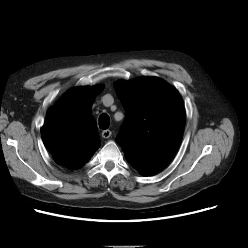 Bronchial stenosis - lung transplant (Radiopaedia 73133-83848 Axial non-contrast 16).jpg