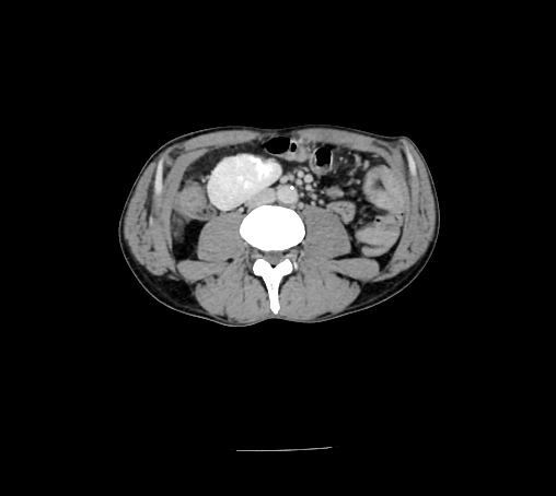 Bronchiectasis in Crohn disease (Radiopaedia 60311-67977 B 94).jpg