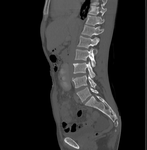 Bronchiectasis in Crohn disease (Radiopaedia 60311-67977 Sagittal bone window 108).jpg