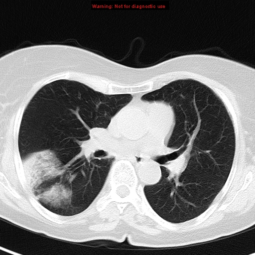 File:Bronchoalveolar carcinoma (BAC) (Radiopaedia 13436-13392 Axial lung window 25).jpg