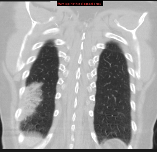 File:Bronchoalveolar carcinoma (BAC) (Radiopaedia 13436-13392 Coronal lung window 52).jpg