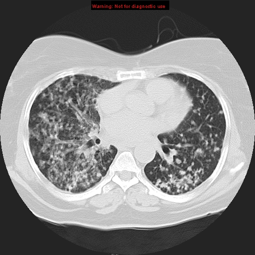 Bronchoalveolar carcinoma (Radiopaedia 13224-13233 Axial lung window 26).jpg