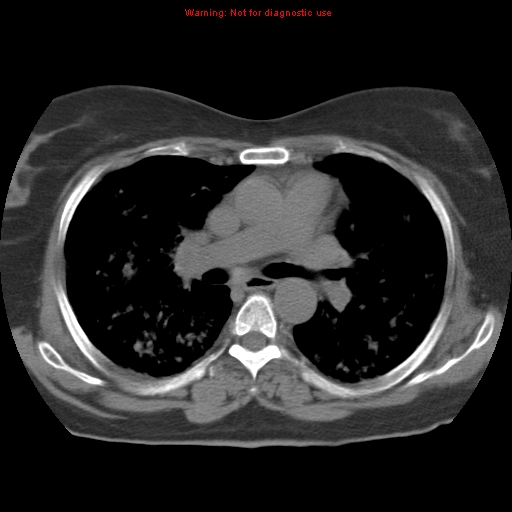 Bronchoalveolar carcinoma (Radiopaedia 13224-13233 Axial non-contrast 21).jpg