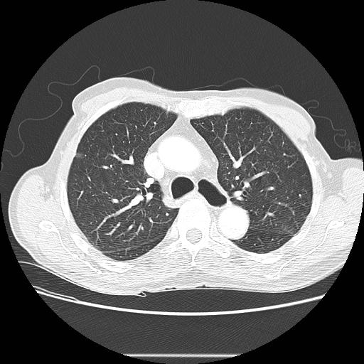 File:Bronchocele (Radiopaedia 17097-16795 Axial lung window 41).jpg