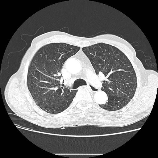 File:Bronchocele (Radiopaedia 17097-16795 Axial lung window 47).jpg