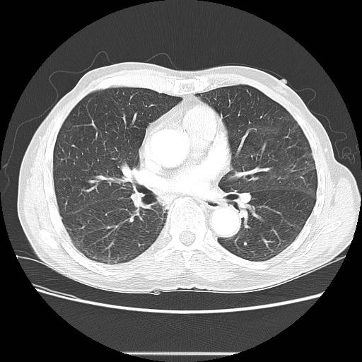 Bronchocele (Radiopaedia 17097-16795 Axial lung window 63).jpg