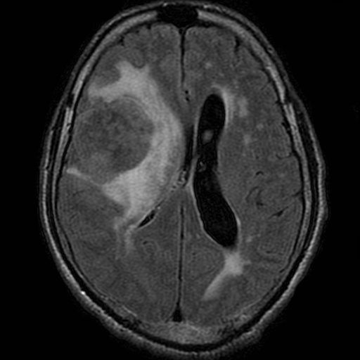 File:Bronchogenic carcinoma brain metastasis (Radiopaedia 9286-9969 Axial FLAIR 1).jpg