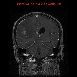 File:Bronchogenic carcinoma brain metastasis (Radiopaedia 9286-9969 Coronal T1 7).jpg
