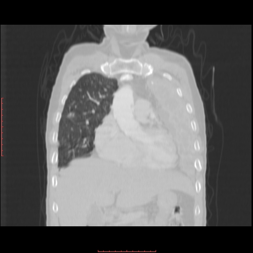 File:Bronchogenic carcinoma with left atrial large deposit - T4N3M1a (Radiopaedia 42316-45428 Coronal lung window 5).jpg