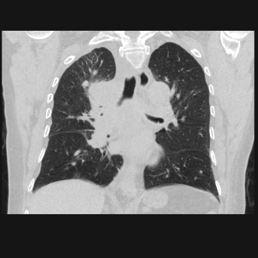 File:Bronchogenic carcinoma with metastatic lymphadenopathy (Radiopaedia 37671-39569 Coronal lung window 27).jpg