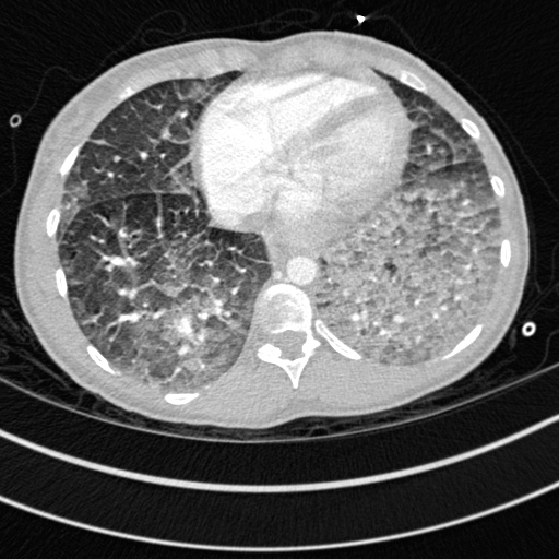 Bronchogenic cyst (Radiopaedia 77801-90071 Axial lung window 61).jpg