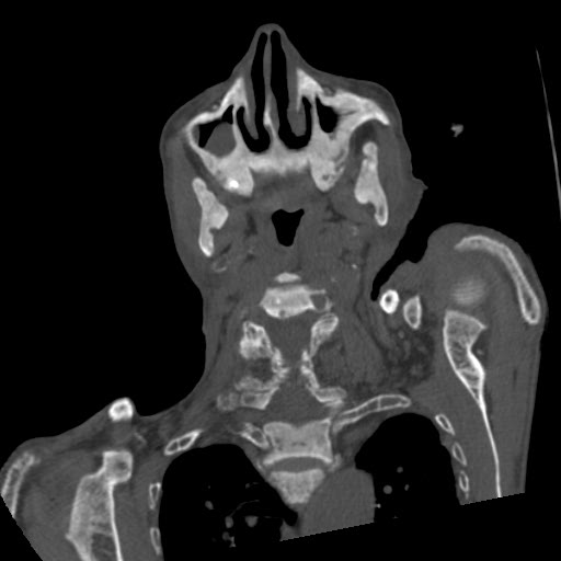 File:Brown tumor with secondary hyperparathyroidism (Radiopaedia 23591-23705 C 27).jpg