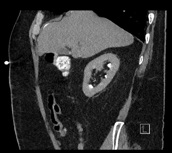 Buried bumper syndrome - gastrostomy tube (Radiopaedia 63843-72577 Sagittal Inject 88).jpg