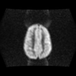 File:Burkitt lymphoma of the orbit- pre and post chemotherapy (Radiopaedia 31214-31929 Axial DWI 12).jpg