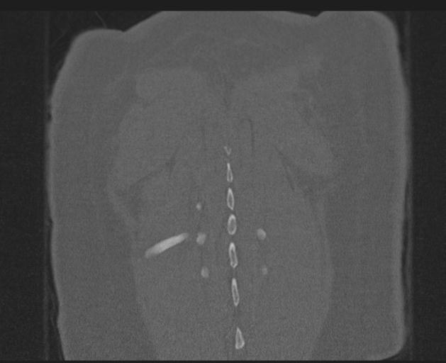 Burst fracture - thoracic spine (Radiopaedia 30238-30865 Coronal bone window 149).jpg