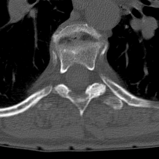 Butterfly vertebrae with kyphoscoliosis (Radiopaedia 14257-14133 Axial bone window 10).jpg