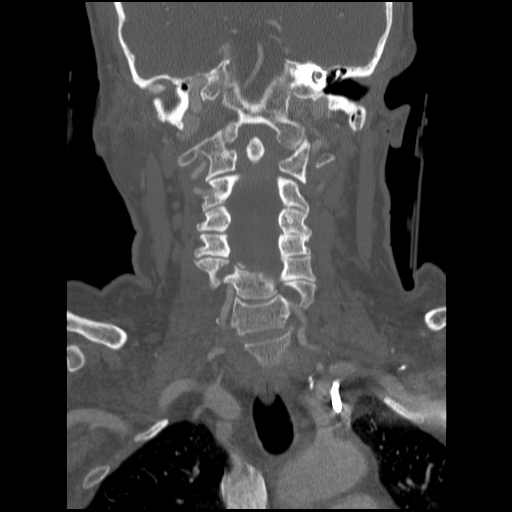 File:C1 anterior arch (plough) fracture - type 1 (Radiopaedia 76181-87720 Coronal bone window 52).jpg
