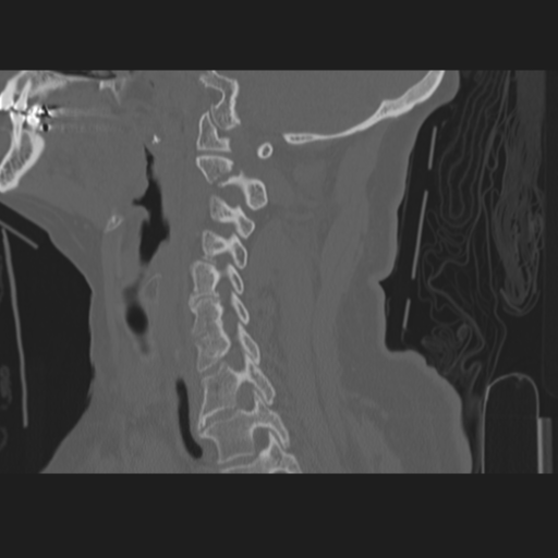 File:C2 fracture (Radiopaedia 34091-35341 Sagittal bone window 30).png