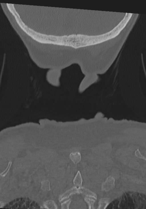 C2 fracture with vertebral artery dissection (Radiopaedia 37378-39199 Coronal bone window 61).png