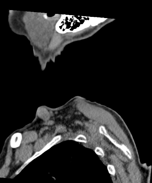 C2 fracture with vertebral artery dissection (Radiopaedia 37378-39199 D 3).png
