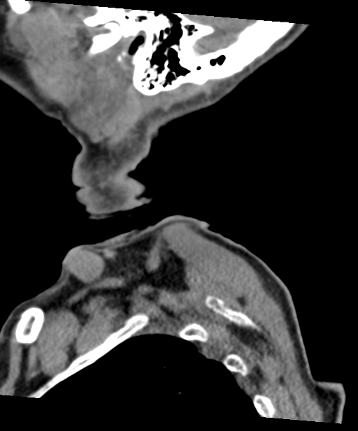 C2 fracture with vertebral artery dissection (Radiopaedia 37378-39199 D 77).png