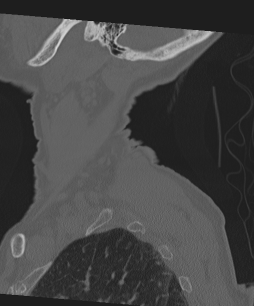 C2 fracture with vertebral artery dissection (Radiopaedia 37378-39199 Sagittal bone window 10).png