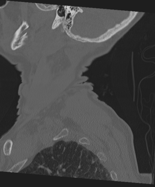 C2 fracture with vertebral artery dissection (Radiopaedia 37378-39199 Sagittal bone window 70).png