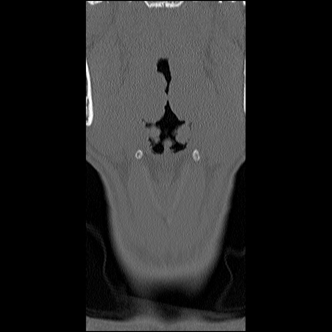 C5 facet fracture (Radiopaedia 58374-65499 Coronal bone window 8).jpg