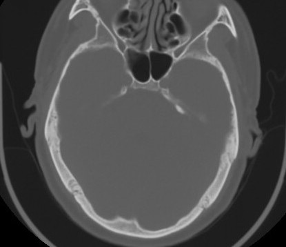 C7 laminar fracture and Klippel-Feil syndrome (Radiopaedia 86710-102850 Axial bone window 7).jpg
