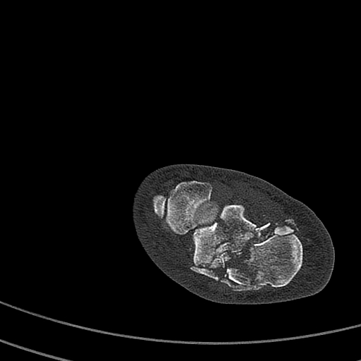 File:Calcaneal fracture - Sanders type 4 (Radiopaedia 90179-107370 Axial bone window 35).jpg