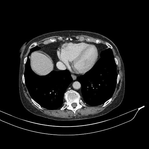 Calcified adrenal glands and Spigelian hernia (Radiopaedia 49741-54988 A 14).jpg