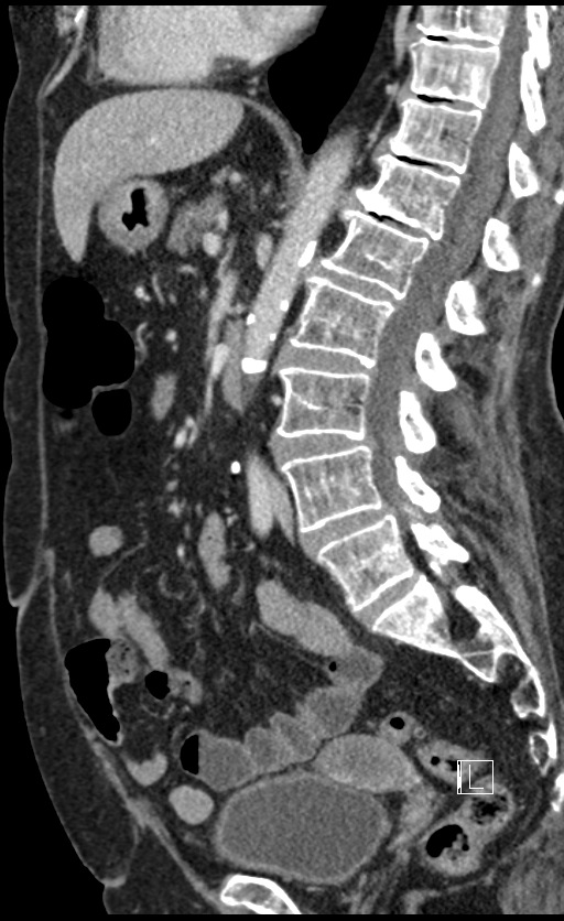 Calcified adrenal glands and Spigelian hernia (Radiopaedia 49741-54988 C 84).jpg