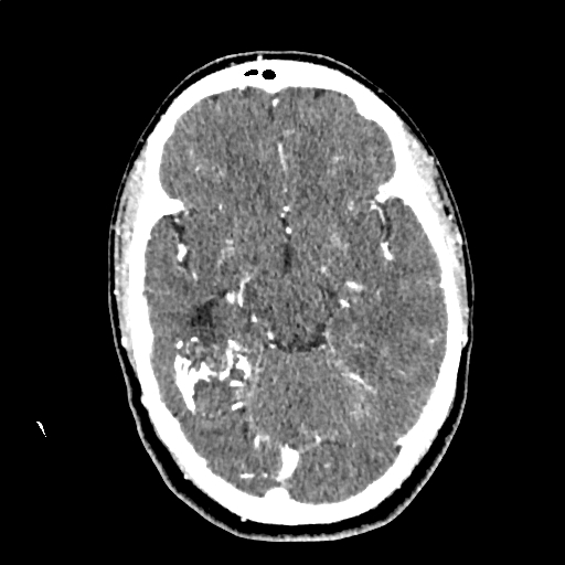 File:Calcified cerebral hydatid cyst (Radiopaedia 65603-74717 Axial with contrast 28).jpg