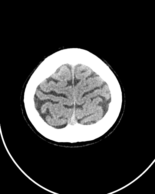 Calcified meningioma (Radiopaedia 74361-85243 Axial non-contrast 7).jpg