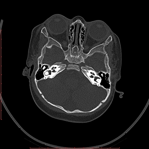 Calcified middle cerebral artery embolism (Radiopaedia 78949-91860 Axial bone window 5).jpg