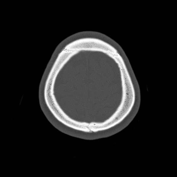 Calvarial osteoma (Radiopaedia 36520-38079 Axial bone window 95).jpg