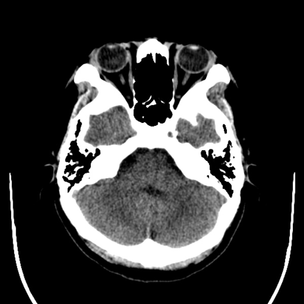 Calvarial osteoma (Radiopaedia 36520-38079 Axial non-contrast 14).jpg