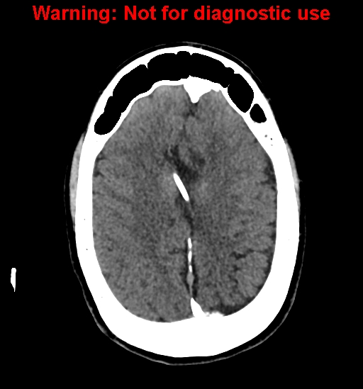 File:Calvarial thickening from chronic shunting (Radiopaedia 60079-67637 Axial non-contrast 21).jpg