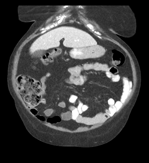 Cannonball metastases from endometrial cancer (Radiopaedia 42003-45031 F 19).png